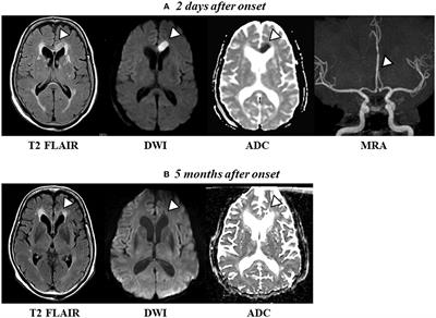 Case report: Self-restraint in a patient with alien hand syndrome following cerebral infarction involving the anterior cerebral artery territory